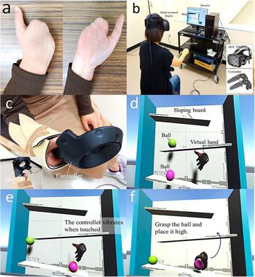 Case Report: Virtual reality training for phantom limb pain after amputation